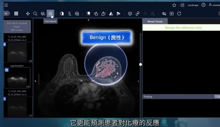 科大研发分析磁力共振（MRI）影像的AI模型MOME