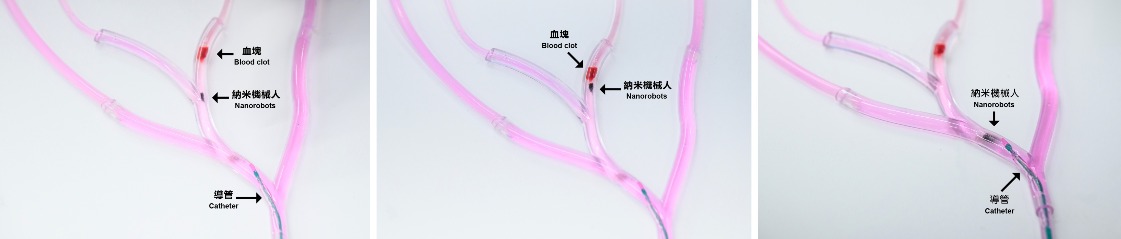 置入導管後，磁控納米機械人到達血栓位置，進行快速溶解血栓，被導航回到導管附近。